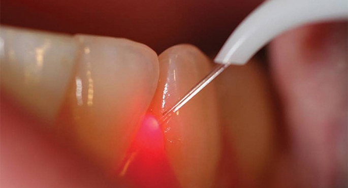 Dzięki laserowi unika się strachu przed bólem w czasie wizyty u dentysty